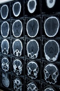 Las Vegas Brain Injury Lawyer FAQs